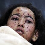 Une fille yéménite blessée lors d'un raid de la coalition conduite par Riyad. D. R.